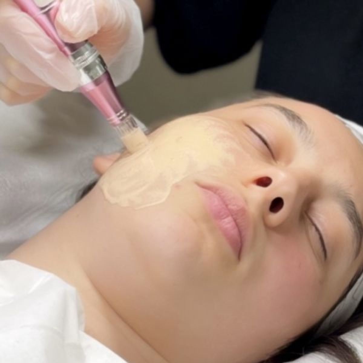 Microneedling BB GLOW à Toulon (83) Par Juliana - Estheca