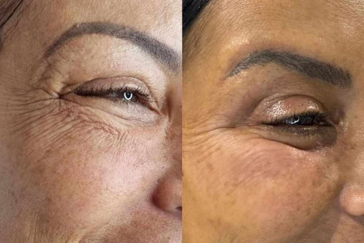 Jett Plasma lift - lifting sans Chirurgie -  à Paris (75) Par Fonseca - Estheca