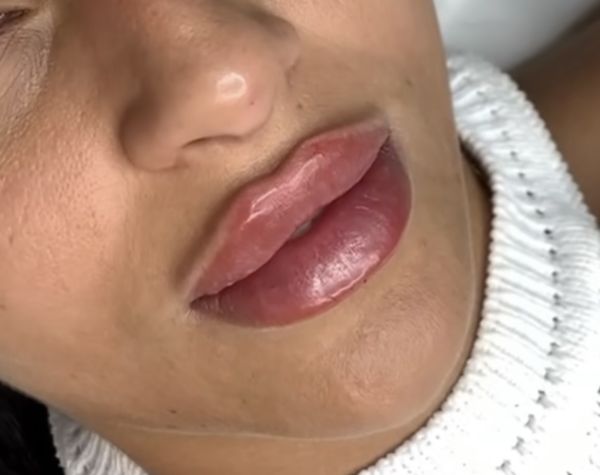 À Toulouse | Russian lips / Augmentation des lèvres | Les meilleures esthéticiennes