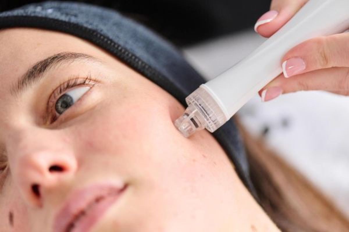 Microneedling/NANO                                  à Lens (62) Par Audrey - Estheca