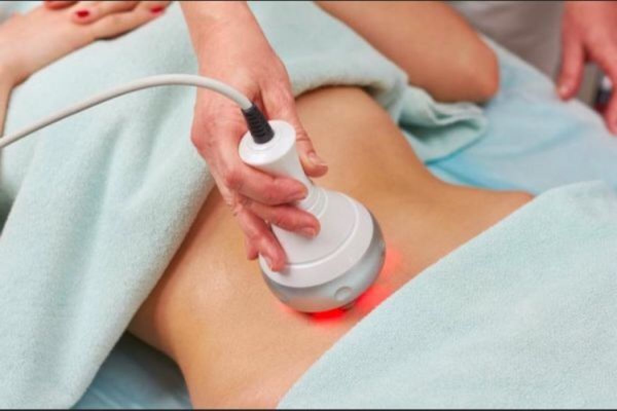 Lipocavitation - Radio fréquence à Lille (59) Par Myriam - Estheca