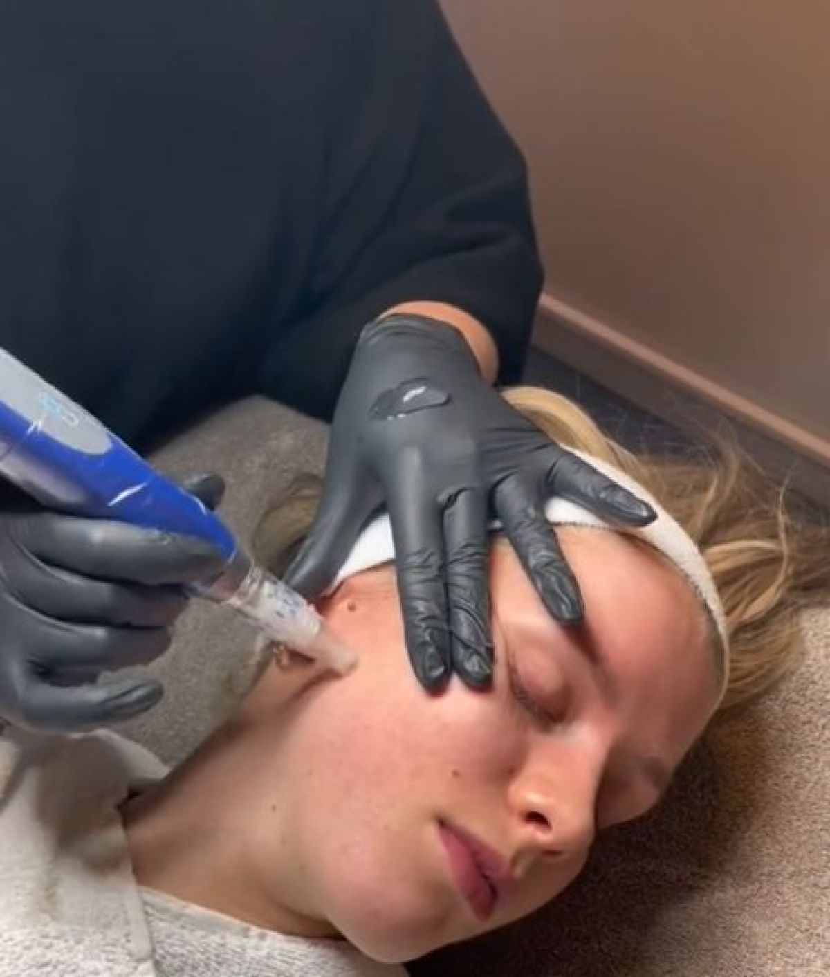 Microneedling BB GLOW à Genlis (21) Par Sonia - Estheca