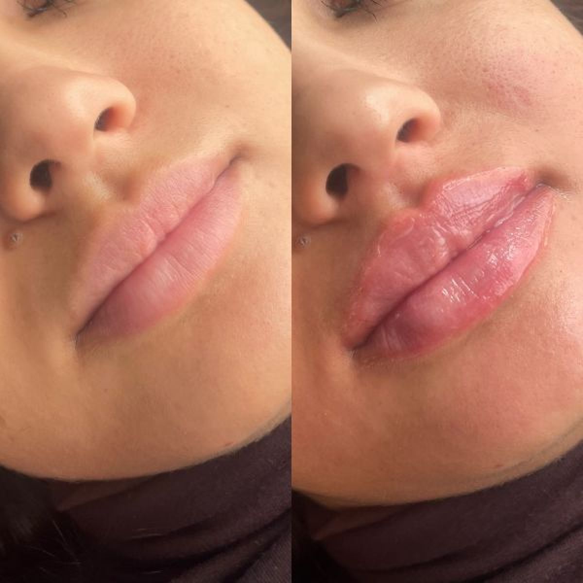 Russian lips / Augmentation des lèvres à Tours (37) Par Anais - Estheca