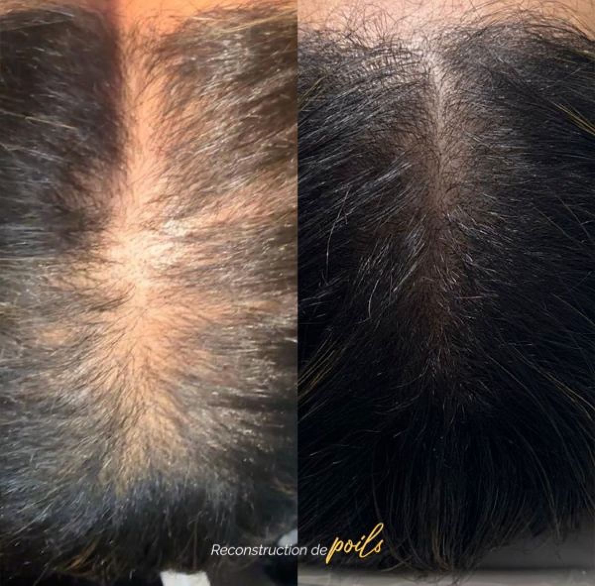 Reconstitution du poil et des cheveux à Marseille (13) Par Isabelle - Estheca